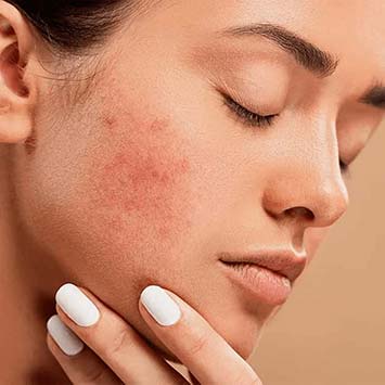 Acne & Pimples