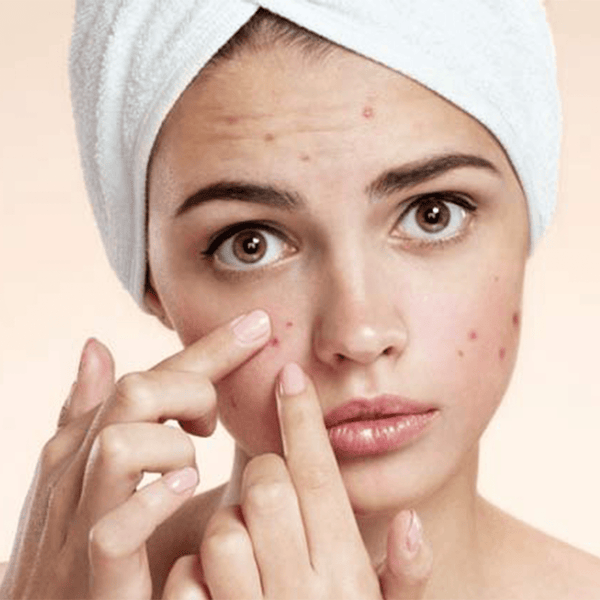 Acne Marks