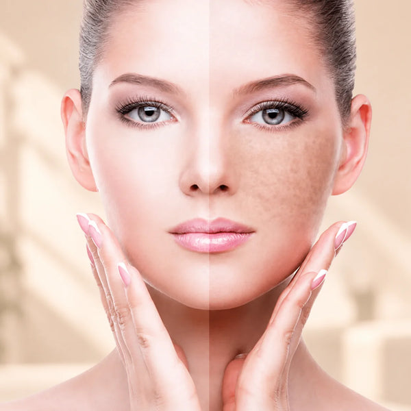 Pigmentation